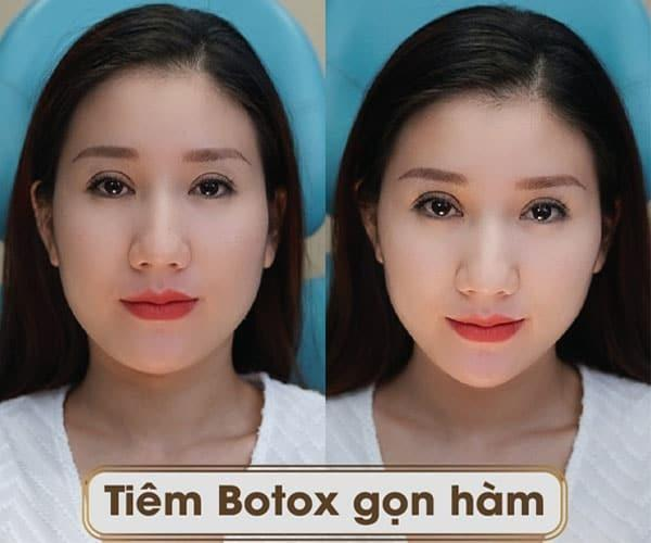 tiêm botox