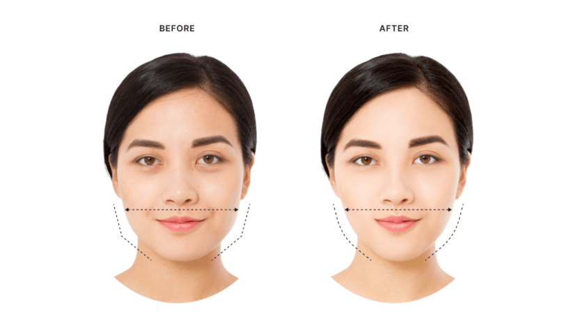 Tiêm Botox gọn hàm