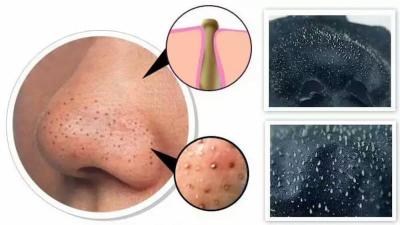 Cách trị mụn đầu đen tại nhà an toàn, hạn chế tái phát