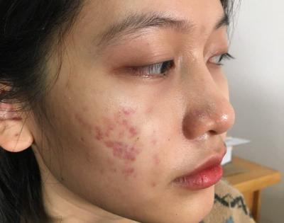 Mách bạn 5 cách trị thâm mụn dễ áp dụng cho người bận rộn