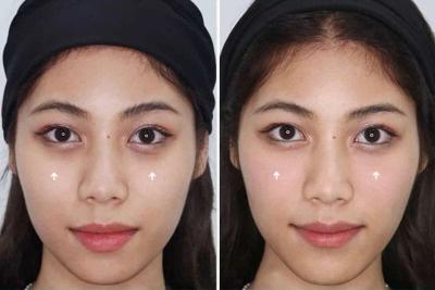 Trị thâm quầng mắt: khi nào nên chuyển từ trị tại nhà sang spa?