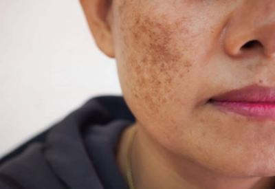 Melanin là gì? Tác động và những thói quen dễ khiến da sạm màu