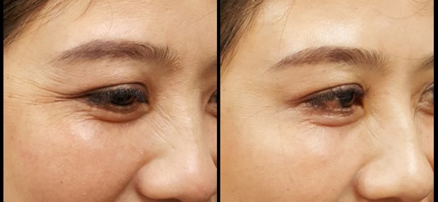 da-mat-truoc-va-sau-khi-tiem-botox