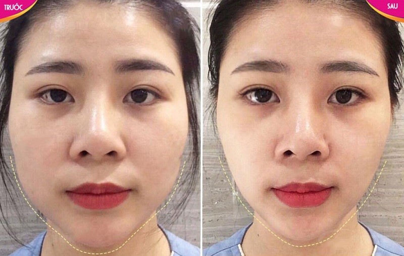 ket-qua-tiem-botox-thu-gon-ham