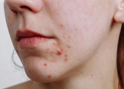 Cách trị thâm mụn nhanh nhất tại nhà giúp da sáng mịn chỉ sau 7 ngày