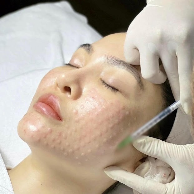 Những ai không nên tiêm meso căng bóng