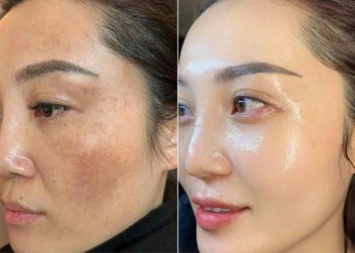 Cách Trị Nám Gò Má Tại Nhà: Lộ Trình Khoa Học Để Lấy Lại Làn Da Trắng Sáng