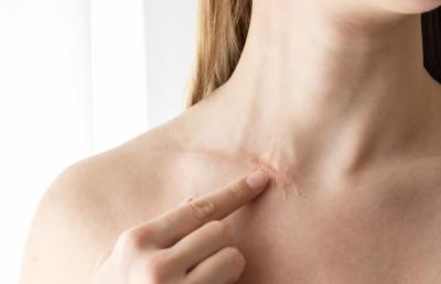 Phương Pháp Trị Sẹo Lồi Lâu Năm Hiệu Quả Nhất Hiện Nay