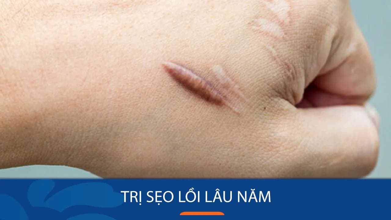 tri-seo-loi-lau-nam