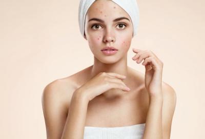 DA BỊ THÂM MỤN PHẢI LÀM SAO? NẮM NGAY BÍ QUYẾT TRỊ MỤN THÂM AN TOÀN VÀ HIỆU QUẢ
