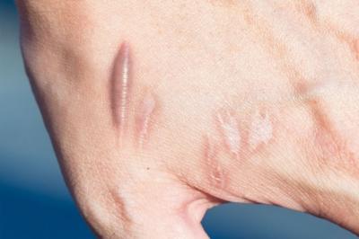 NHỮNG ĐIỀU CẦN BIẾT KHI ĐIỀU TRỊ SẸO LỒI