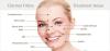 How long does Fillers and Botox effect last?