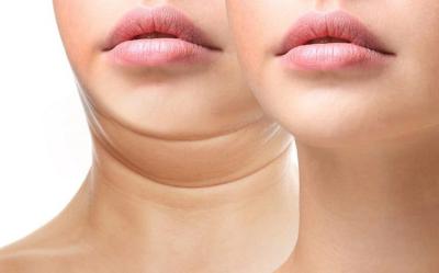 Cách làm hết nọng cằm hiệu quả cho gương mặt V-Line đẹp