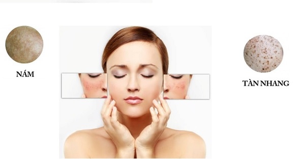 Giữa thâm nám và tàn nhang cái nào dễ điều trị hơn?