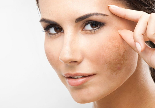 Cách điều trị nám phổ biến nhất chính là phương pháp Laser 