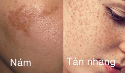 Hỏi: Nám và tàn nhang cái nào dễ điều trị hơn?