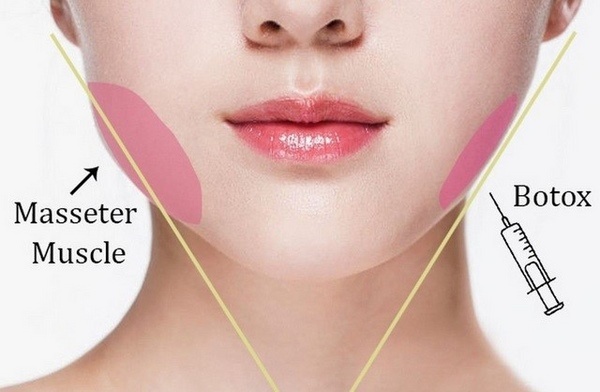 Thus, you do not need to spend too much time and endure painful feelings, but it still brings a balanced, V-line face when using Botox.