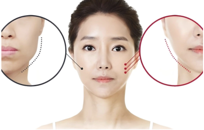 Tiêm botox gọn hàm có nguy hiểm không? Sản phẩm tiêm gọn hàm nào hiệu quả?