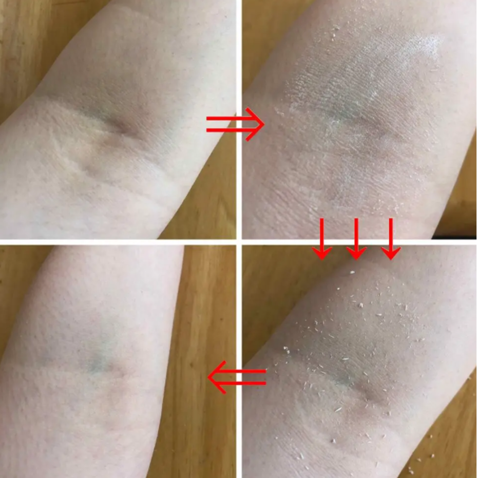 美白外用治療で脇の黒ずみをケアする様子