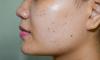 Top 7 Best Treatment for Dark Spots on Face That Actually Work