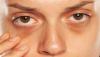How to Remove Dark Circles Under Eyes Permanently?
