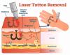 Tattoo Removal Near Me: What to Expect, Costs, and Top Clinics in Your Area