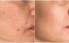 Natural vs. Clinical Hyperpigmentation Skin Treatments: Which Is Right for You?