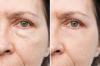 How to Get Rid of Bags Under Eyes: Proven Remedies and Expert Tips
