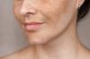 Best Melasma Treatments in 2025: Dermatologist-Approved Solutions for Clearer Skin