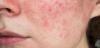 Skin Discoloration Treatment: What Works for Dark Spots vs. Redness