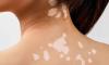 Top In-Clinic Skin Discoloration Treatments You Should Try in 2025