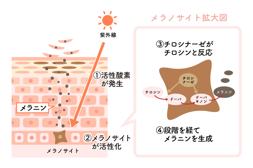 ニキビ跡 色素沈着 紫外線 悪化原因