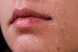 Da bạn đang thiếu nước hay thiếu ẩm? Thấu hiểu làn da để chăm sóc trọn vẹn hơn