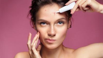 Bí quyết trị mụn ở trán hiệu quả và ngăn ngừa tái phát lâu dài 