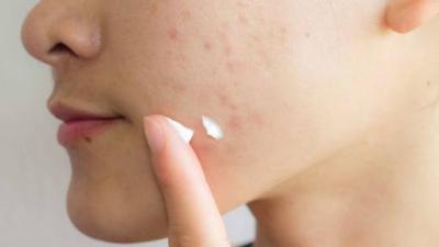Lý Do Mụn Thâm Lâu Không Hết Và Cách Điều Trị Hiệu Quả