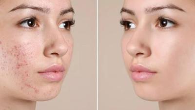 Các Nguyên Nhân Gây Mụn Phổ Biến Nhất: Tại Sao Bạn Luôn Bị Mụn?