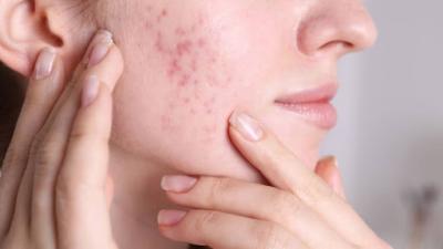 Bí Quyết Skincare Chuẩn Cho Da Thâm Mụn: Lấy Lại Làn Da Sáng Mịn Tự Tin!
