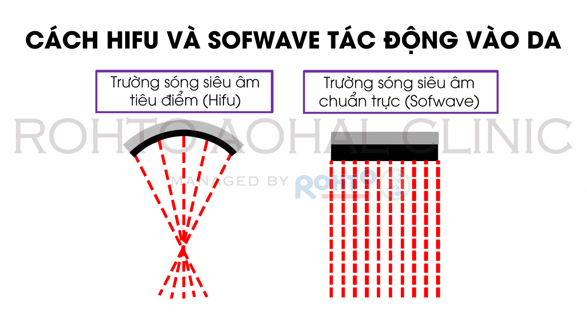Cách HIFU và Sofwave tác động vào da 