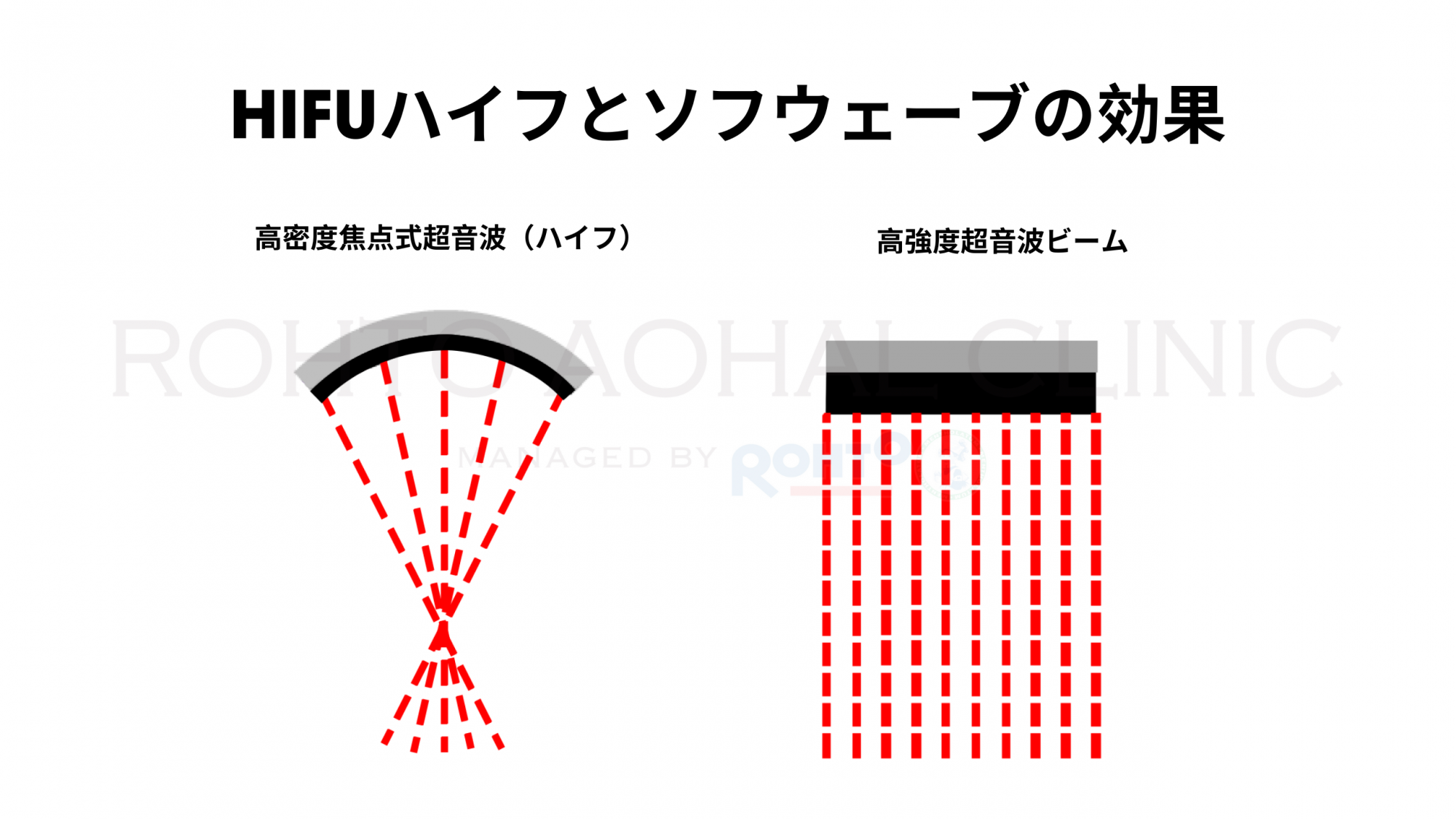 Sofwave JP