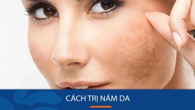 Những phương pháp trị nám tàn nhang tận gốc mới nhất