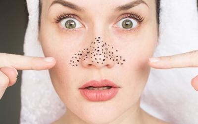 Cách trị mụn đầu đen nhanh chóng mới nhất đang được chị em săn đón