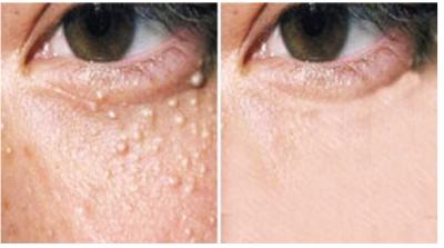 Cách trị mụn thịt nhanh khỏi, không ảnh hưởng đến thẩm mỹ