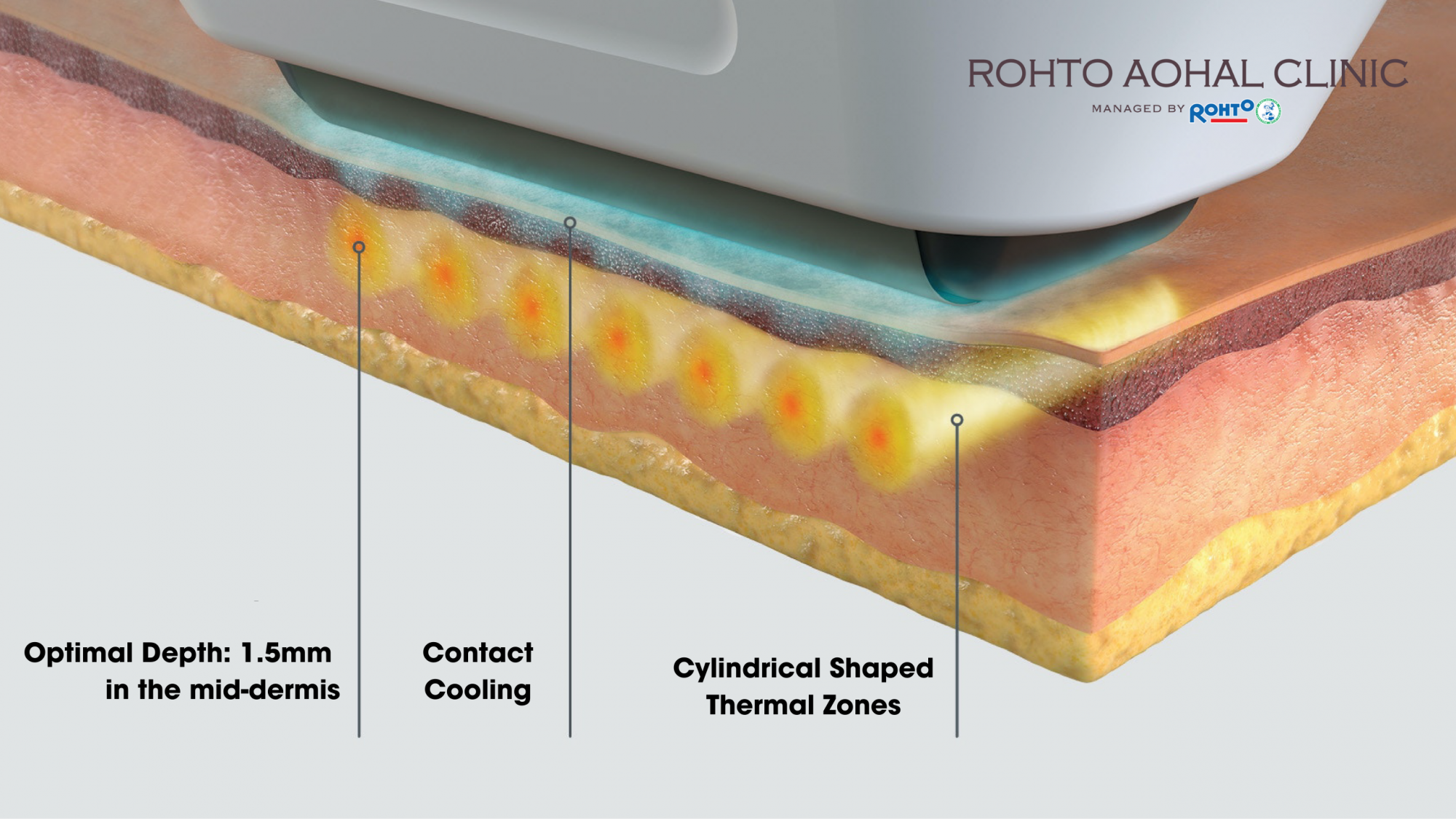 Eng Sofwave cấu tạo