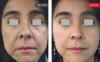 Fotona StarWalker – The King of Stubborn Melasma Treatment: A Comparison Between Fotona StarWalker and Fotona 4D