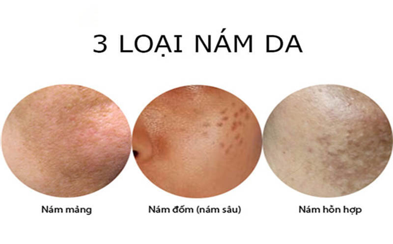 cac-loai-nam-da-mat
