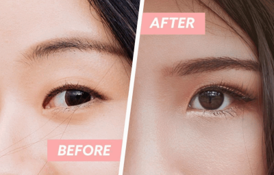 Nâng cơ mí mắt: Hành trang giúp cho đôi mắt sáng rạng rỡ