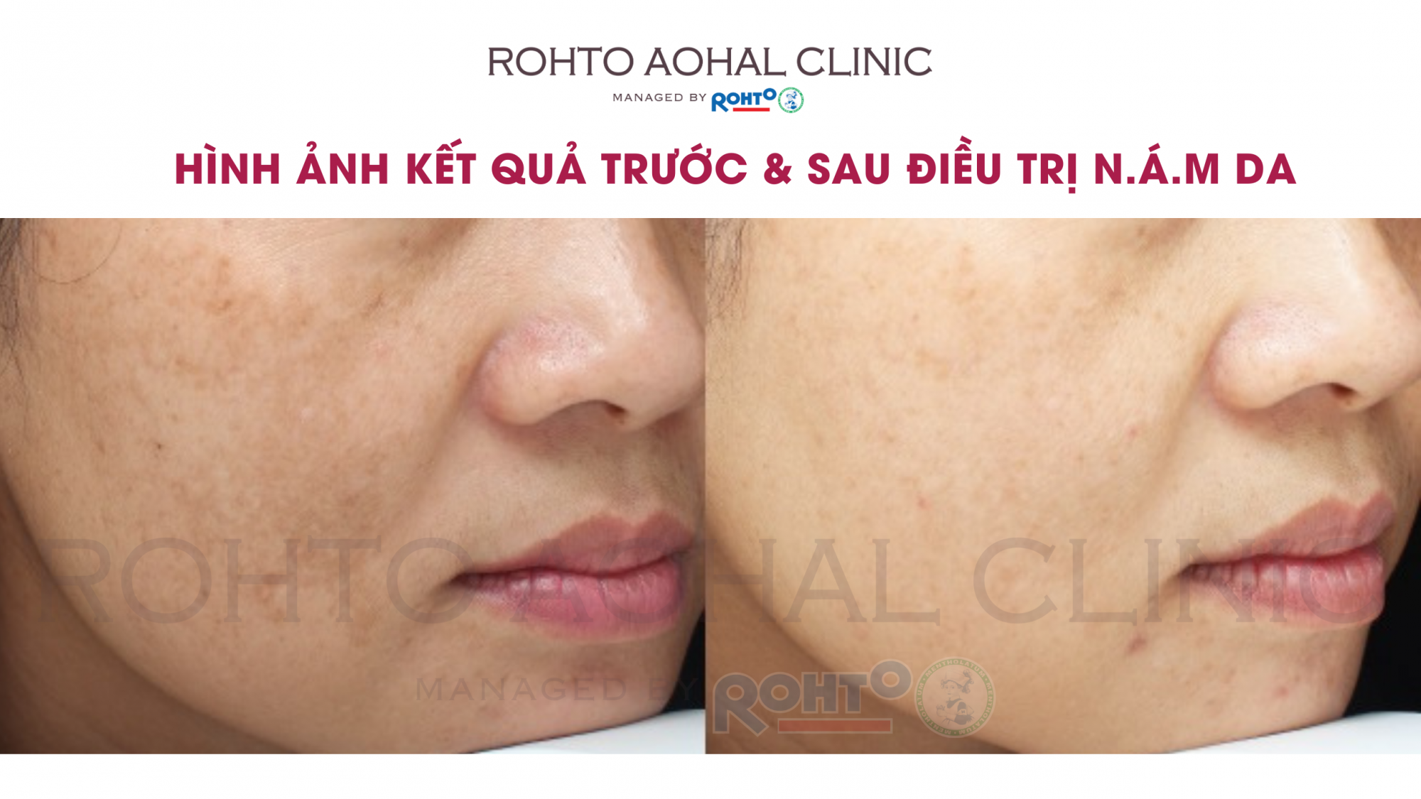 Hình ảnh trước và sau khi điều trị