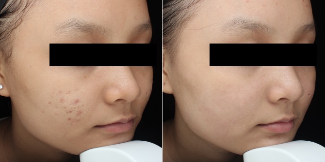 kết-quả-điều-trị-prp-3