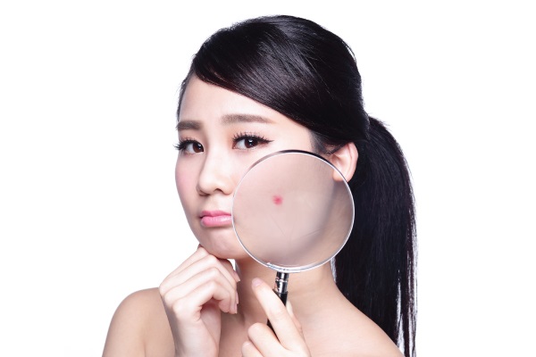 TRỊ MỤN PEEL AHA/BHA