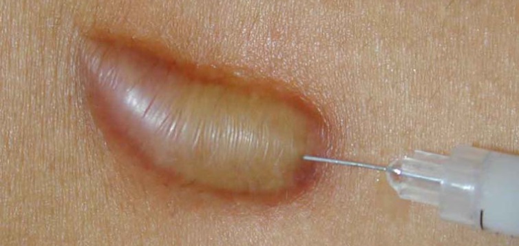 trị-sẹo-lồi-4